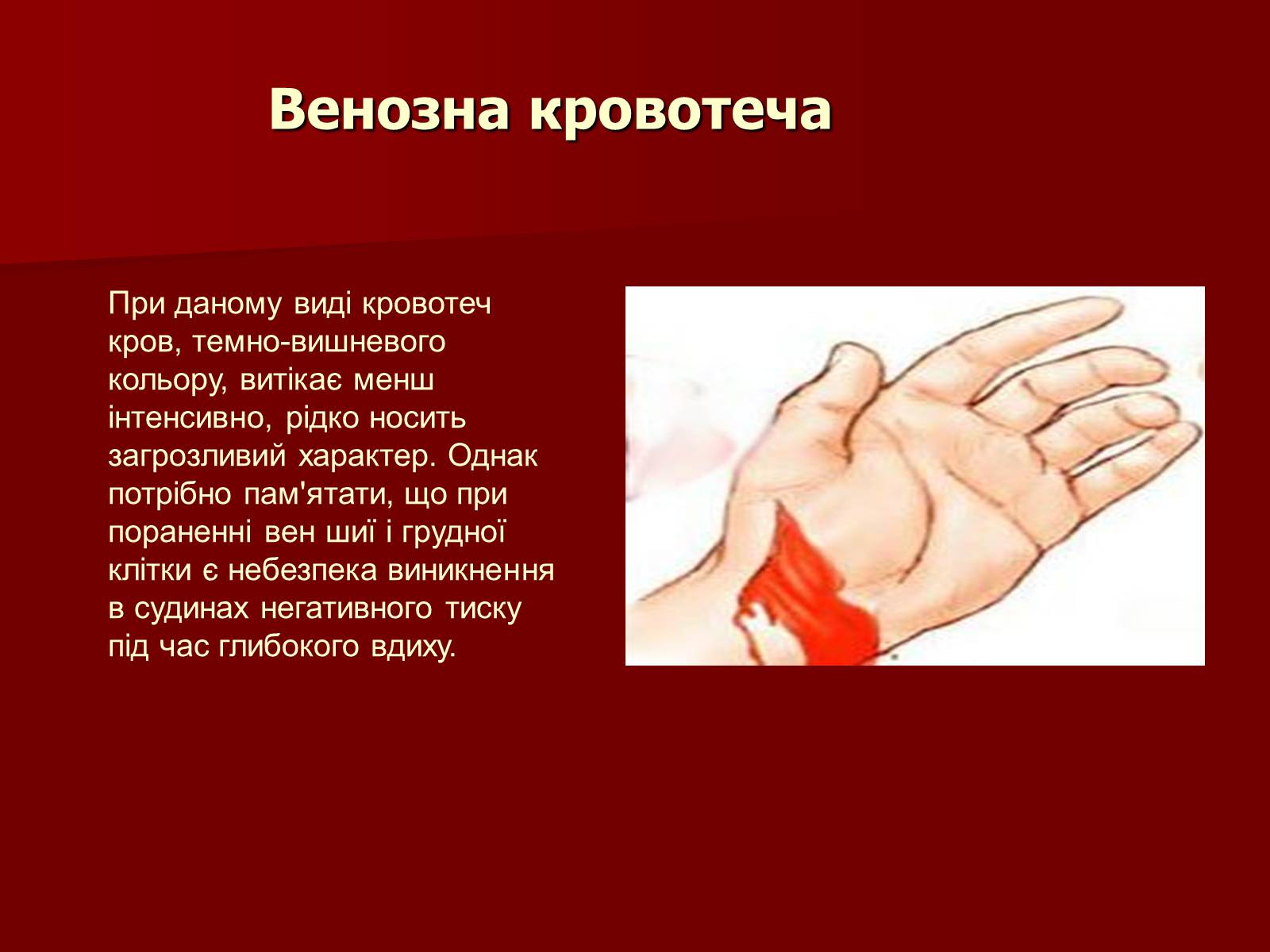 Презентація на тему «Кровотечі, їх класифікація» - Слайд #6 Презентація на тему «Кровотечі, їх класифікація» - Слайд #6