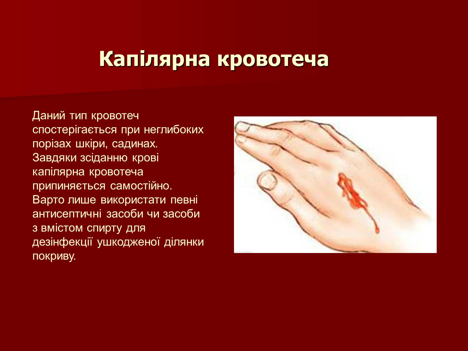 Презентація на тему «Кровотечі, їх класифікація» - Слайд #7 Презентація на тему «Кровотечі, їх класифікація» - Слайд #7