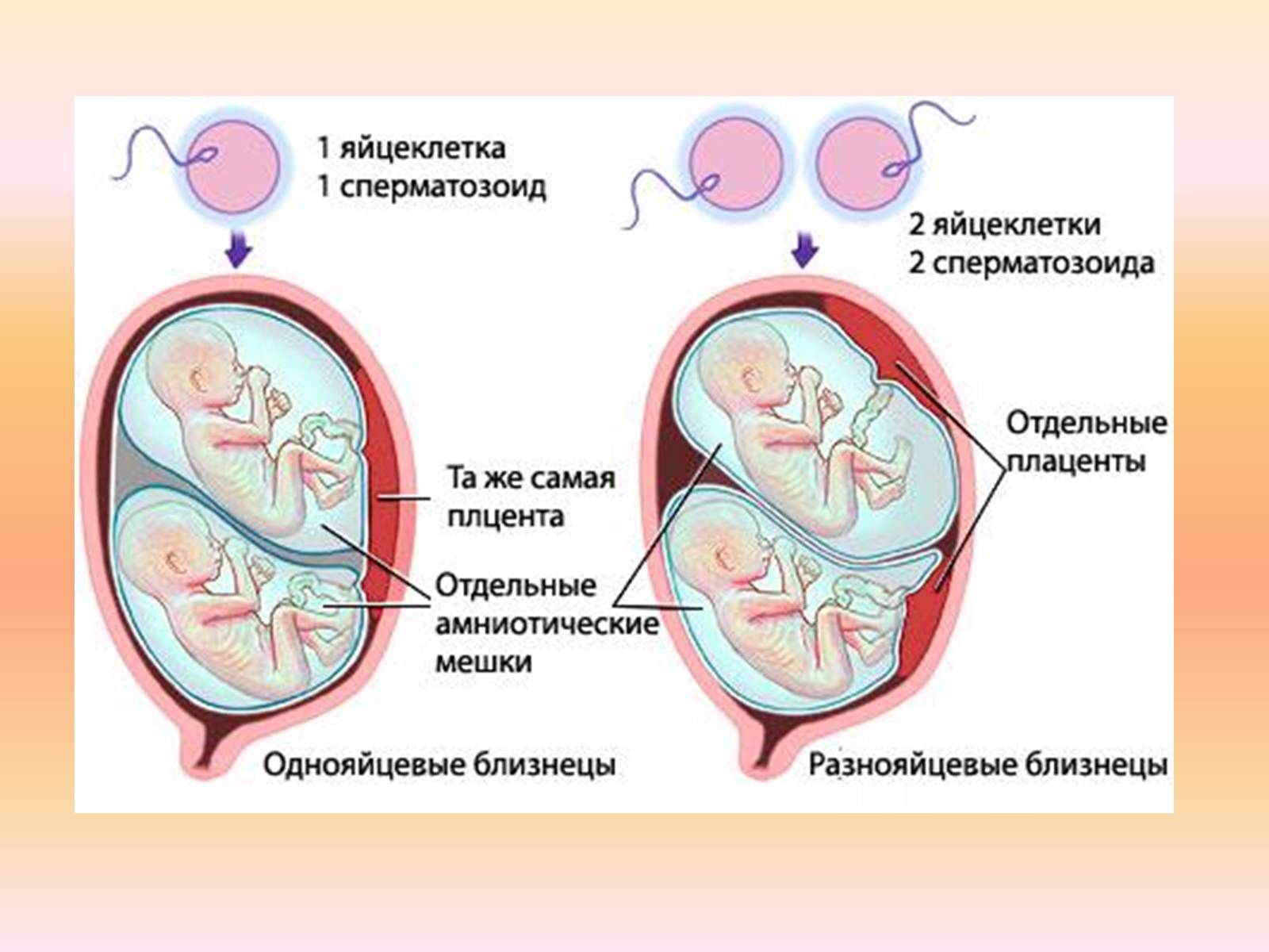 Презентація на тему «Близнецы» - Слайд #6 Презентація на тему «Близнецы» - Слайд #6