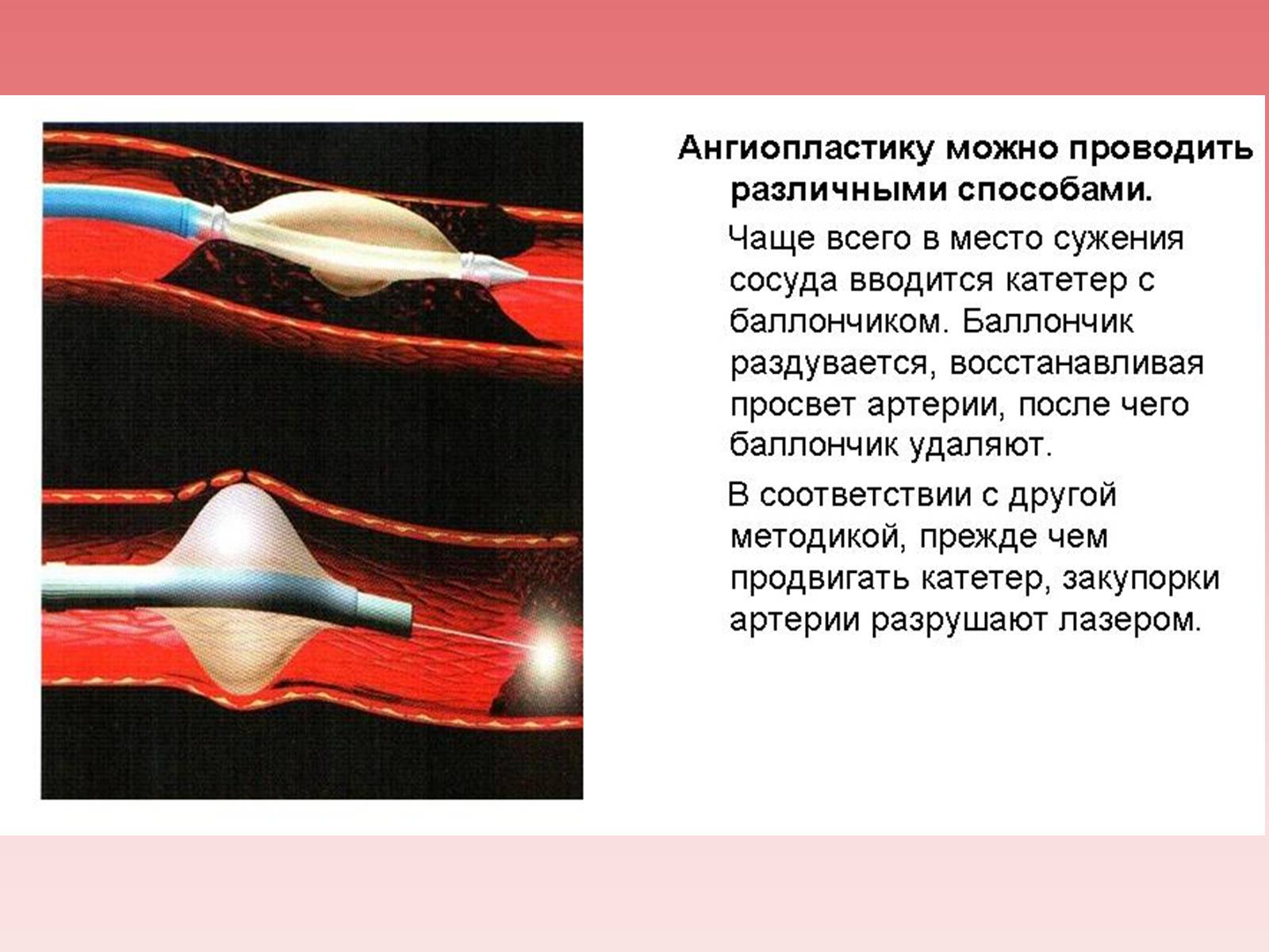 Презентація на тему «Кардиология» - Слайд #17 Презентація на тему «Кардиология» - Слайд #17