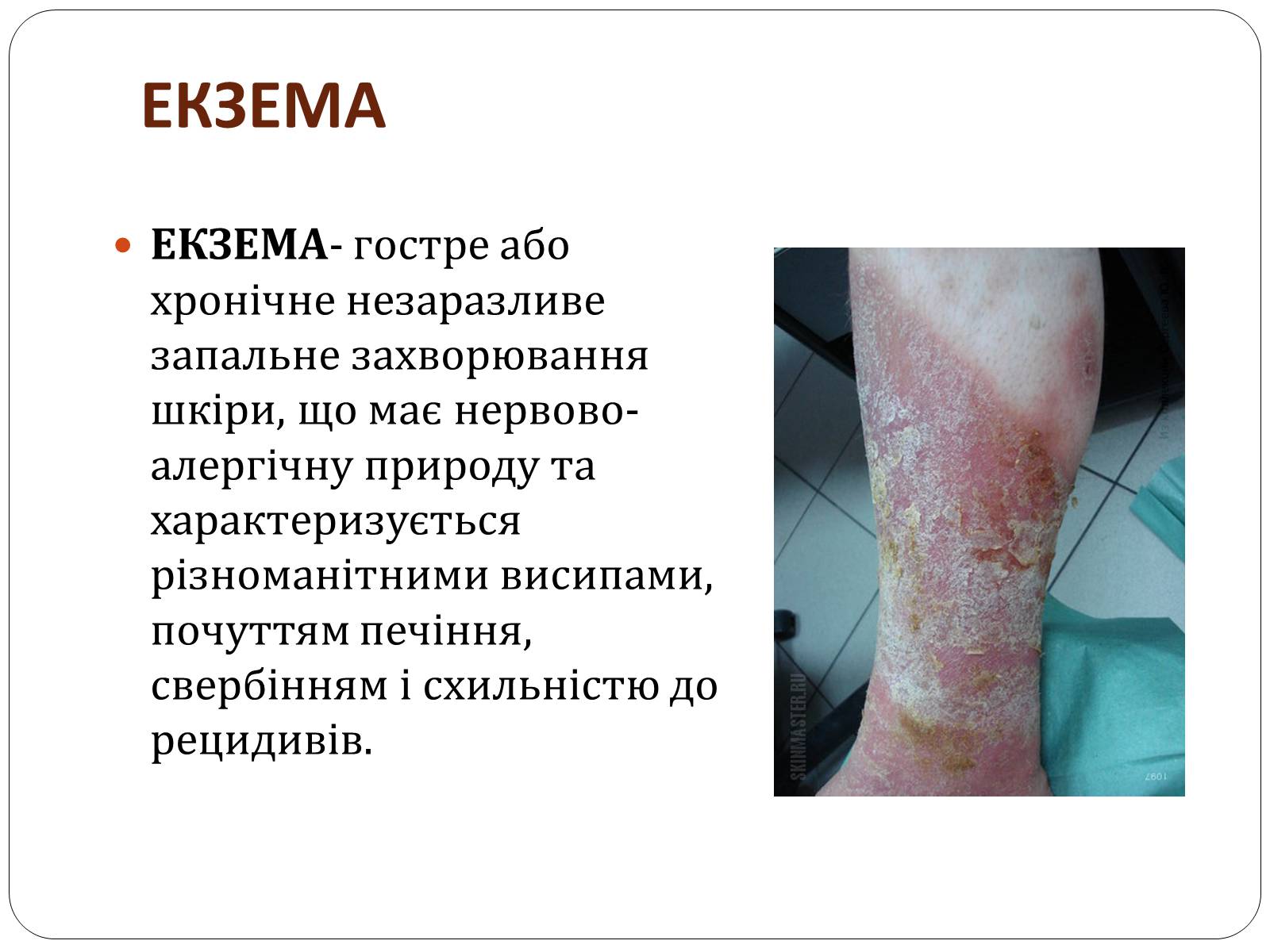 Презентація на тему «Захворювання шкіри» (варіант 3) - Слайд #12 Презентація на тему «Захворювання шкіри» (варіант 3) - Слайд #12