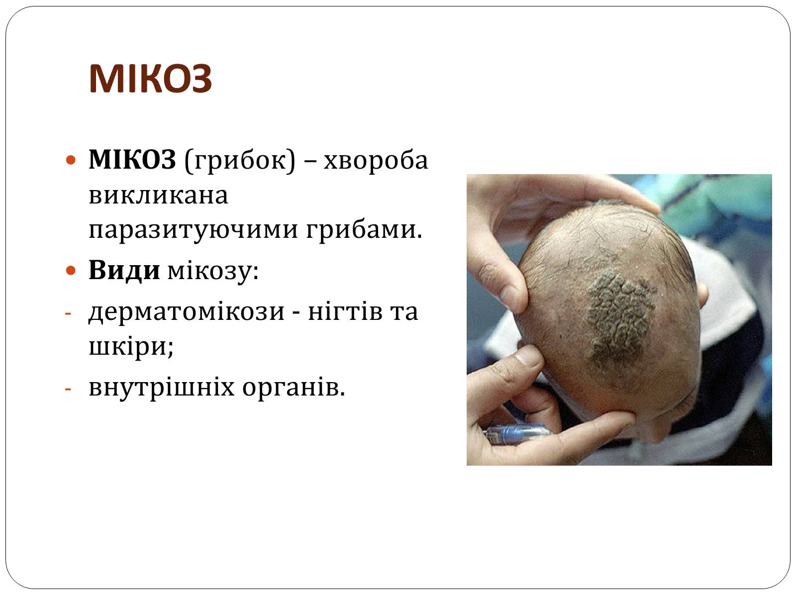 Презентація на тему «Захворювання шкіри» (варіант 3) - Слайд #13 Презентація на тему «Захворювання шкіри» (варіант 3) - Слайд #13