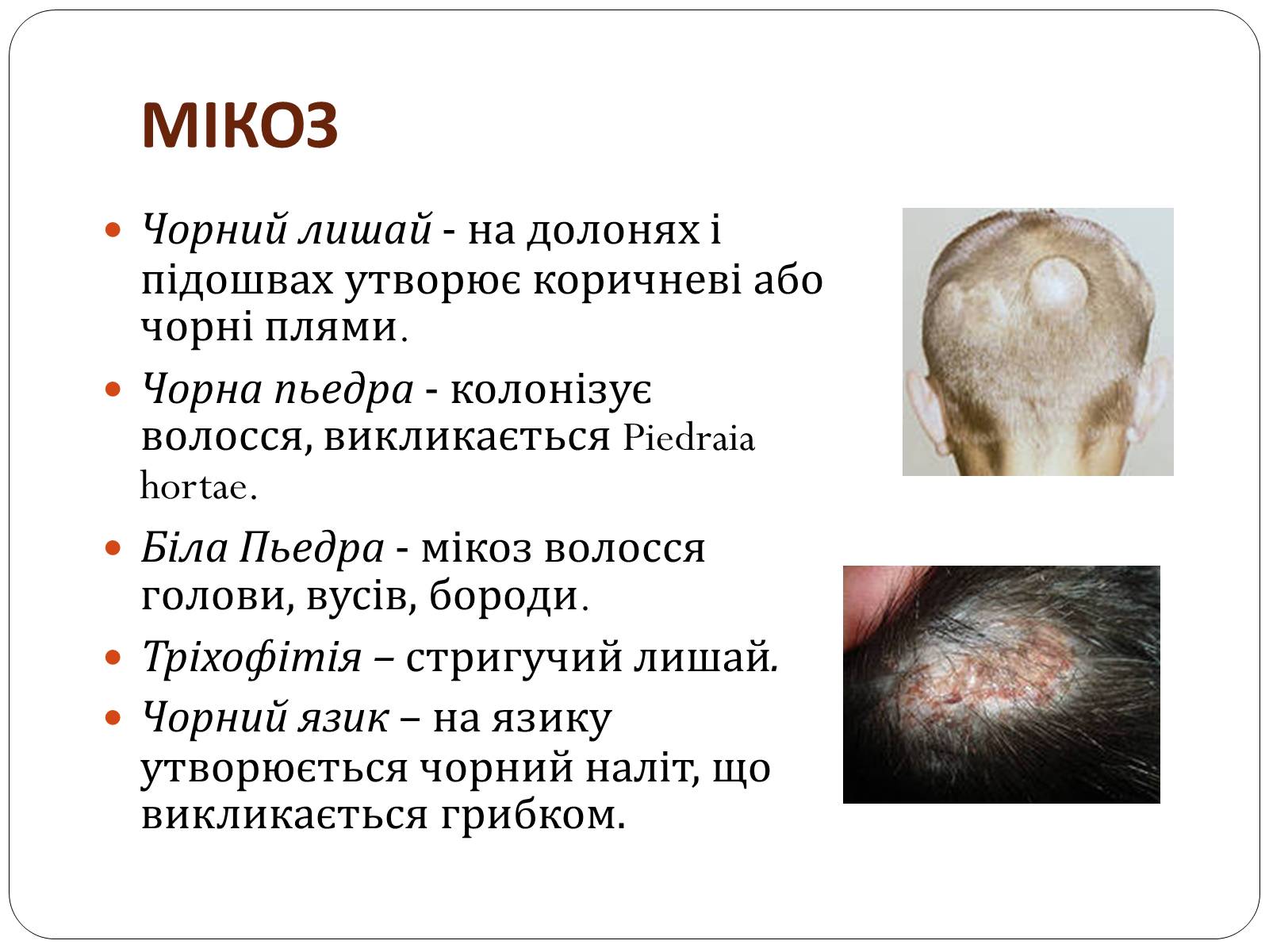 Презентація на тему «Захворювання шкіри» (варіант 3) - Слайд #15 Презентація на тему «Захворювання шкіри» (варіант 3) - Слайд #15