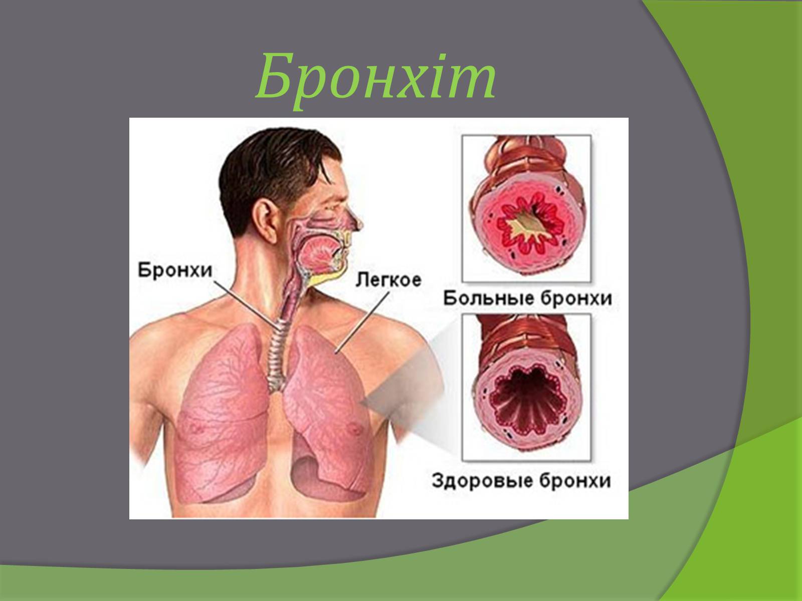 Презентація на тему «Бронхіт» - Слайд #1 Презентація на тему «Бронхіт» - Слайд #1