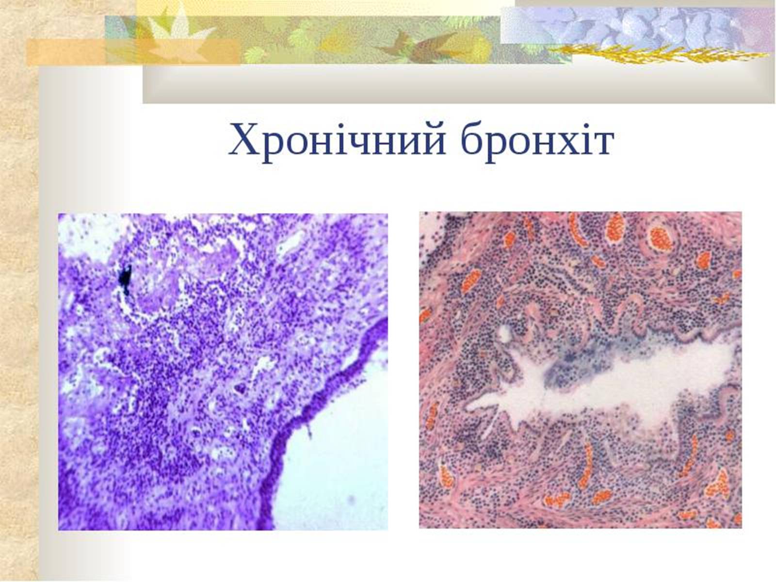 Презентація на тему «Бронхіт» - Слайд #8 Презентація на тему «Бронхіт» - Слайд #8