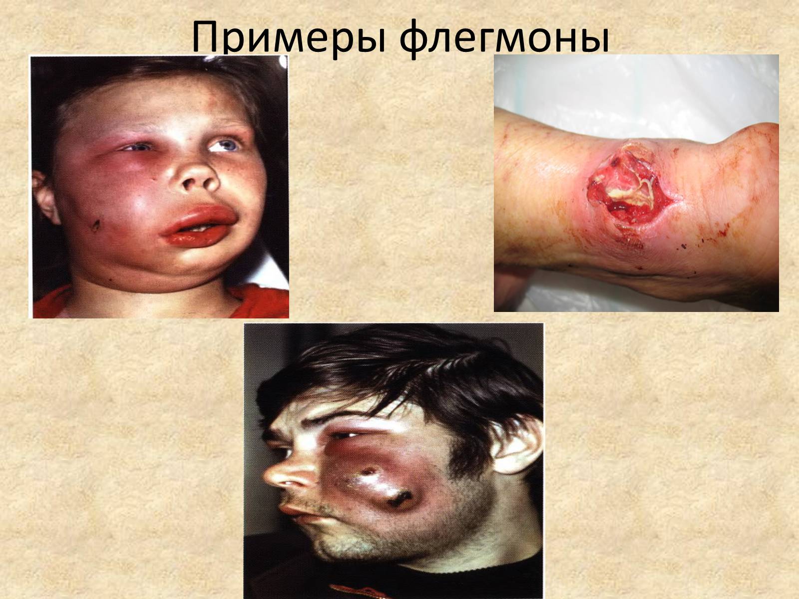 Презентація на тему «Гнойные заболевания кожи и подкожной клетчатки» - Слайд #10 Презентація на тему «Гнойные заболевания кожи и подкожной клетчатки» - Слайд #10