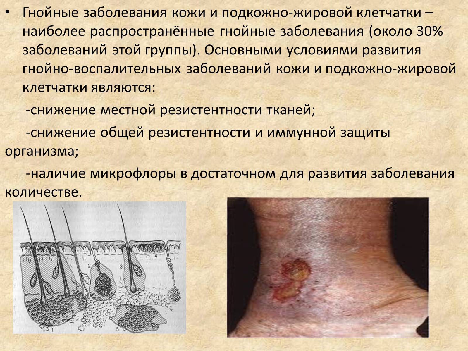Презентація на тему «Гнойные заболевания кожи и подкожной клетчатки» - Слайд #2 Презентація на тему «Гнойные заболевания кожи и подкожной клетчатки» - Слайд #2