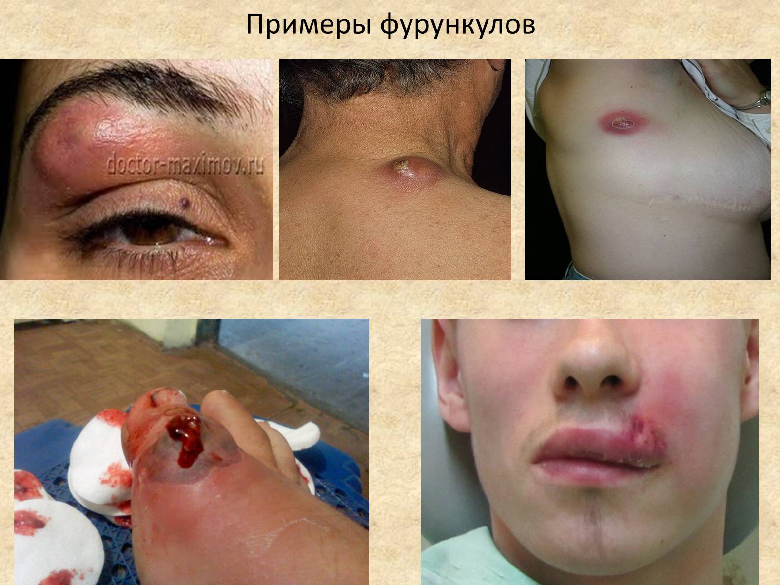 Презентація на тему «Гнойные заболевания кожи и подкожной клетчатки» - Слайд #4 Презентація на тему «Гнойные заболевания кожи и подкожной клетчатки» - Слайд #4