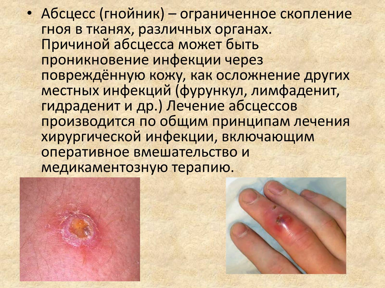 Презентація на тему «Гнойные заболевания кожи и подкожной клетчатки» - Слайд #7 Презентація на тему «Гнойные заболевания кожи и подкожной клетчатки» - Слайд #7