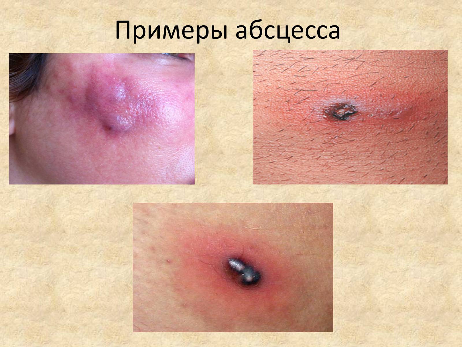 Презентація на тему «Гнойные заболевания кожи и подкожной клетчатки» - Слайд #8 Презентація на тему «Гнойные заболевания кожи и подкожной клетчатки» - Слайд #8