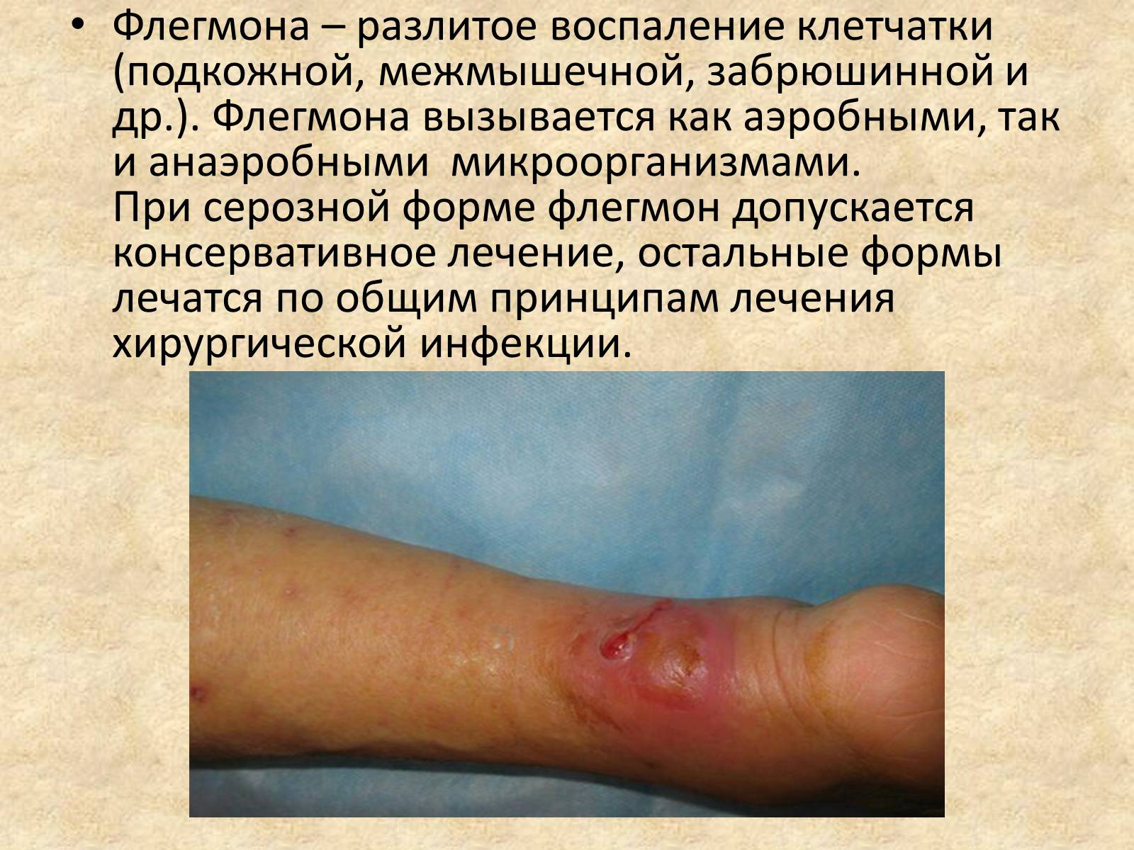 Презентація на тему «Гнойные заболевания кожи и подкожной клетчатки» - Слайд #9 Презентація на тему «Гнойные заболевания кожи и подкожной клетчатки» - Слайд #9