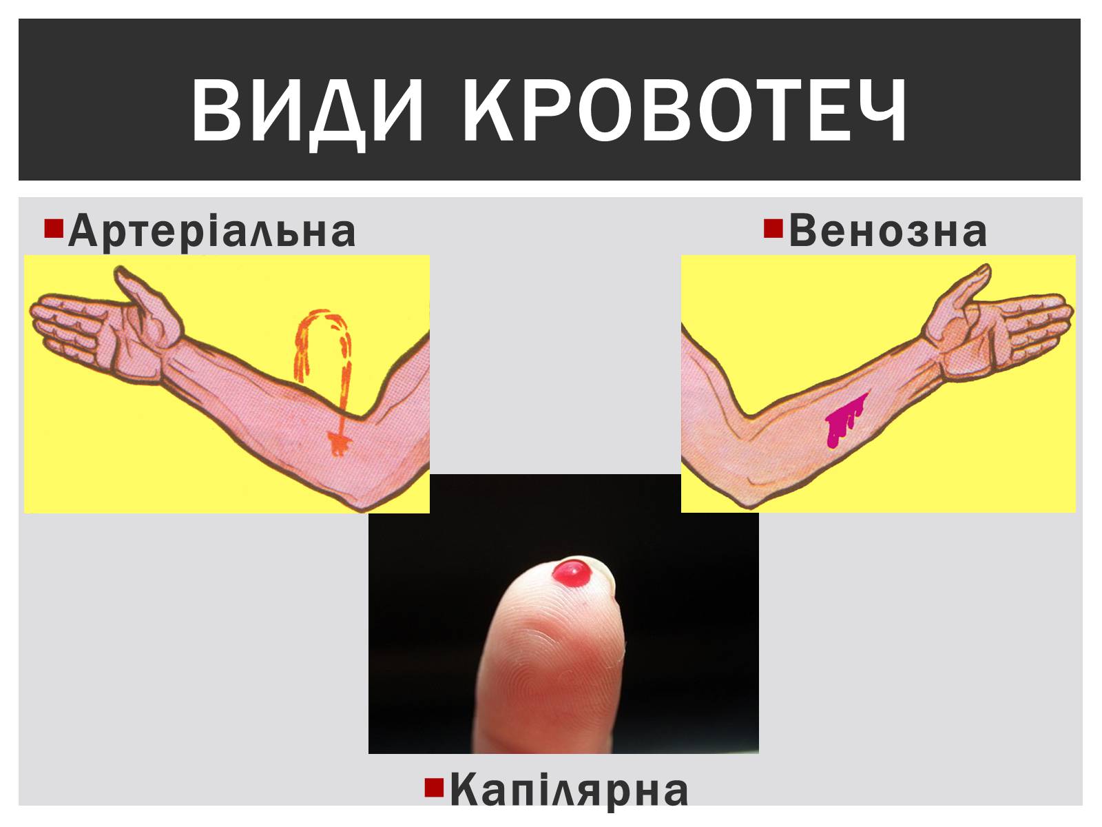 Презентація на тему «Технічна зупинка кровотечі» - Слайд #3 Презентація на тему «Технічна зупинка кровотечі» - Слайд #3