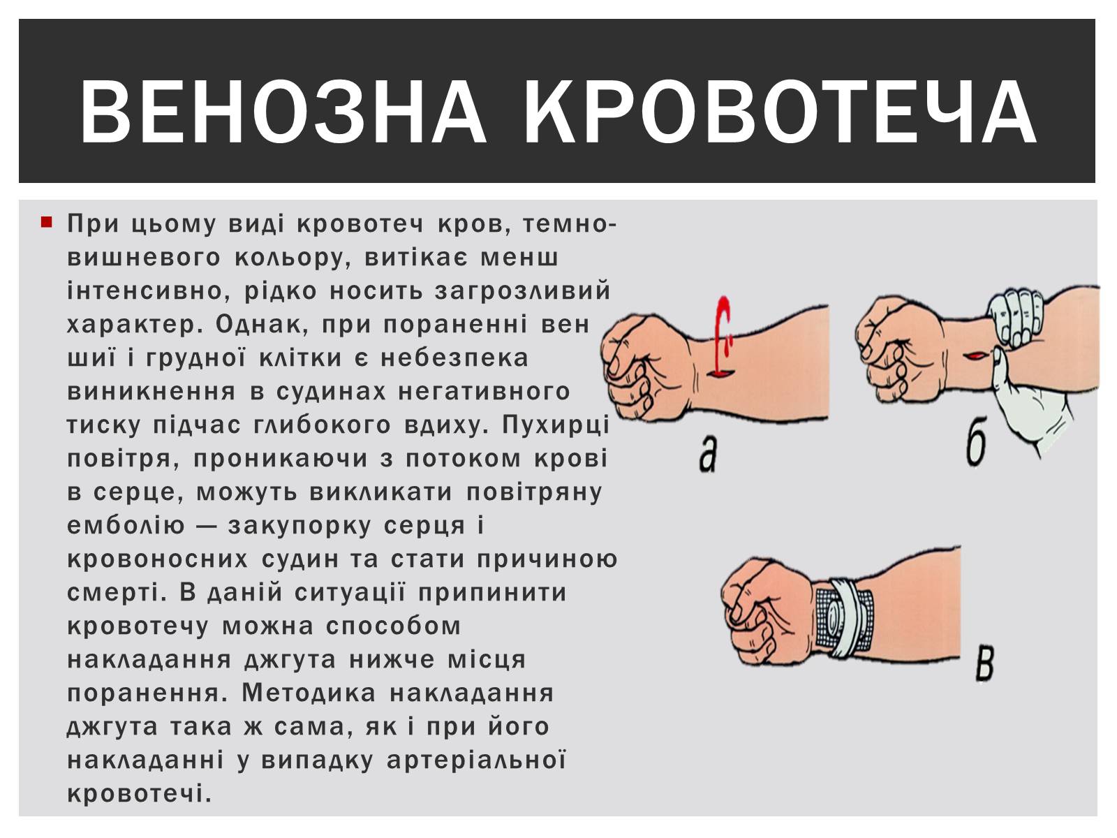 Презентація на тему «Технічна зупинка кровотечі» - Слайд #6 Презентація на тему «Технічна зупинка кровотечі» - Слайд #6