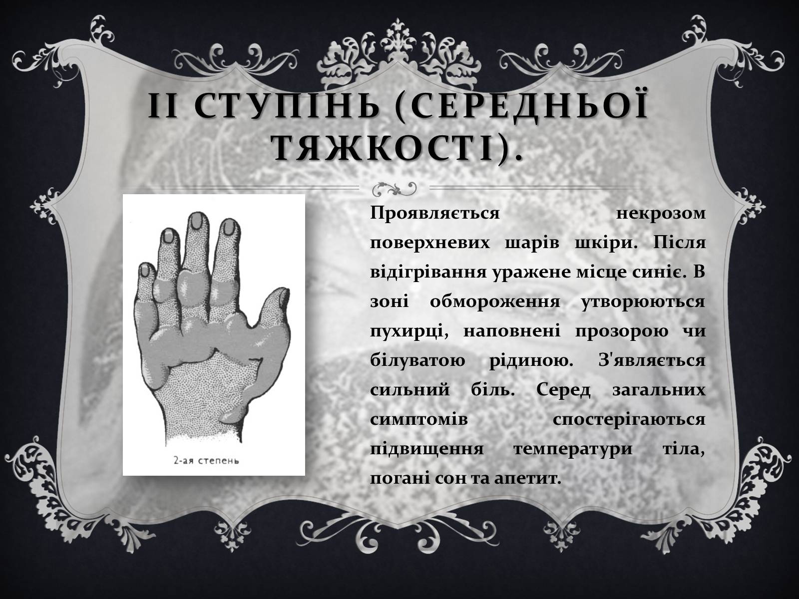 Презентація на тему «Обмороження» (варіант 1) - Слайд #12 Презентація на тему «Обмороження» (варіант 1) - Слайд #12