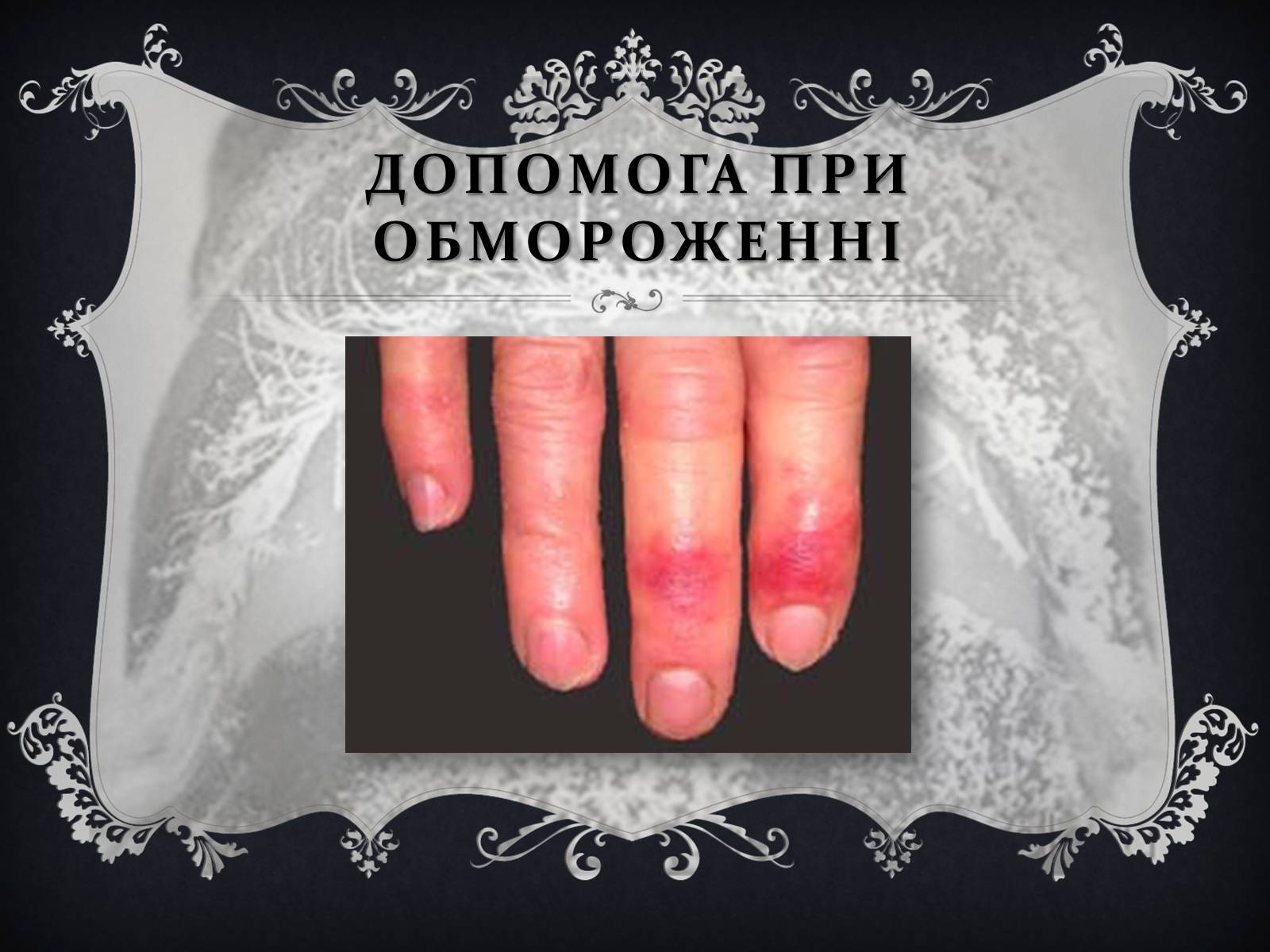Презентація на тему «Обмороження» (варіант 1) - Слайд #15 Презентація на тему «Обмороження» (варіант 1) - Слайд #15