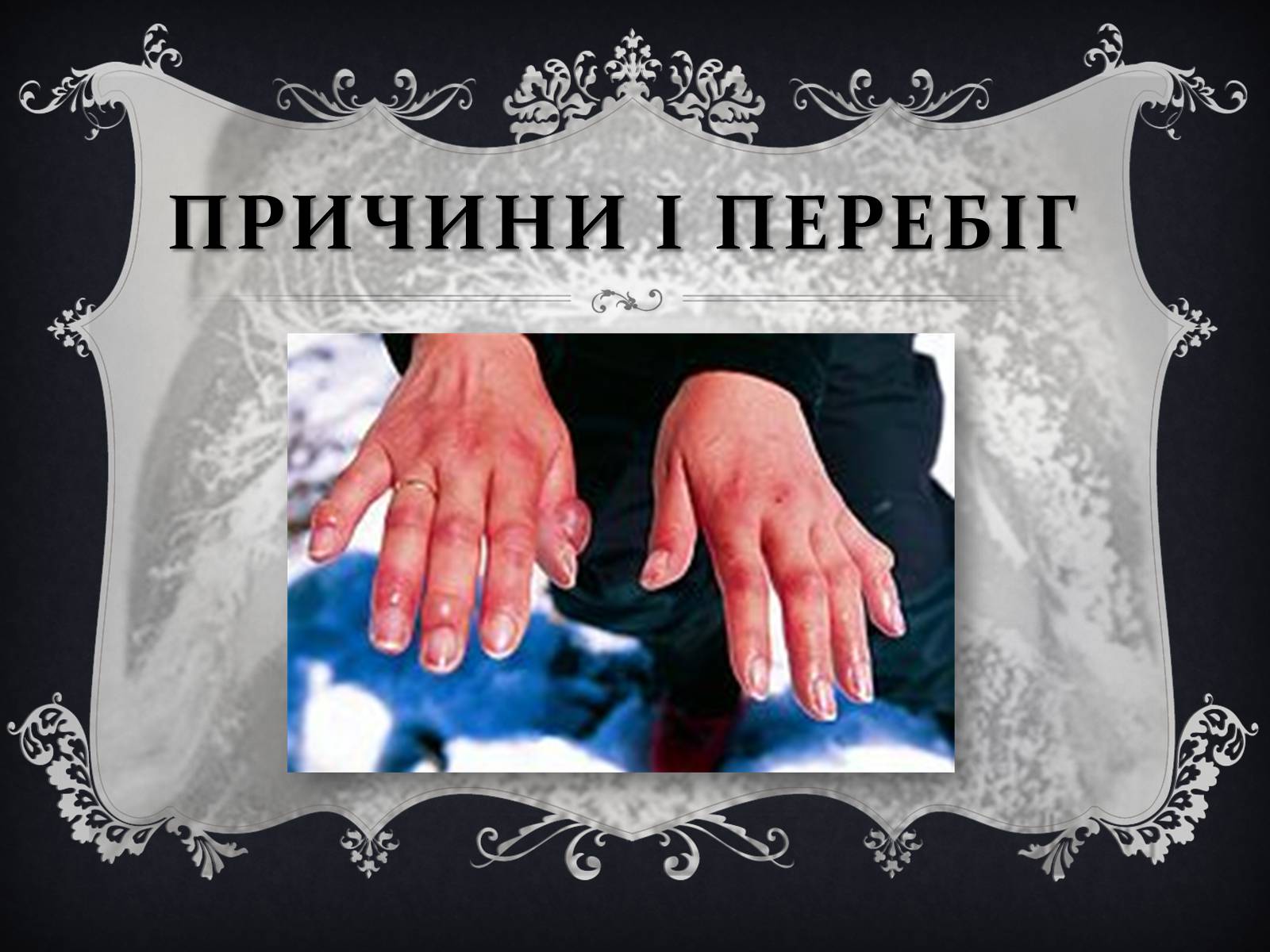 Презентація на тему «Обмороження» (варіант 1) - Слайд #3 Презентація на тему «Обмороження» (варіант 1) - Слайд #3