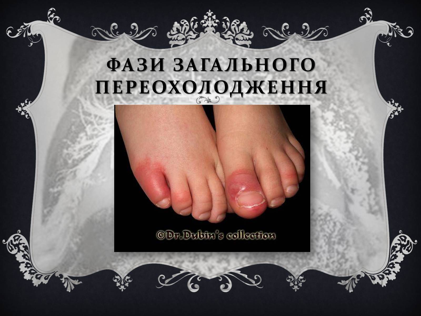 Презентація на тему «Обмороження» (варіант 1) - Слайд #5 Презентація на тему «Обмороження» (варіант 1) - Слайд #5