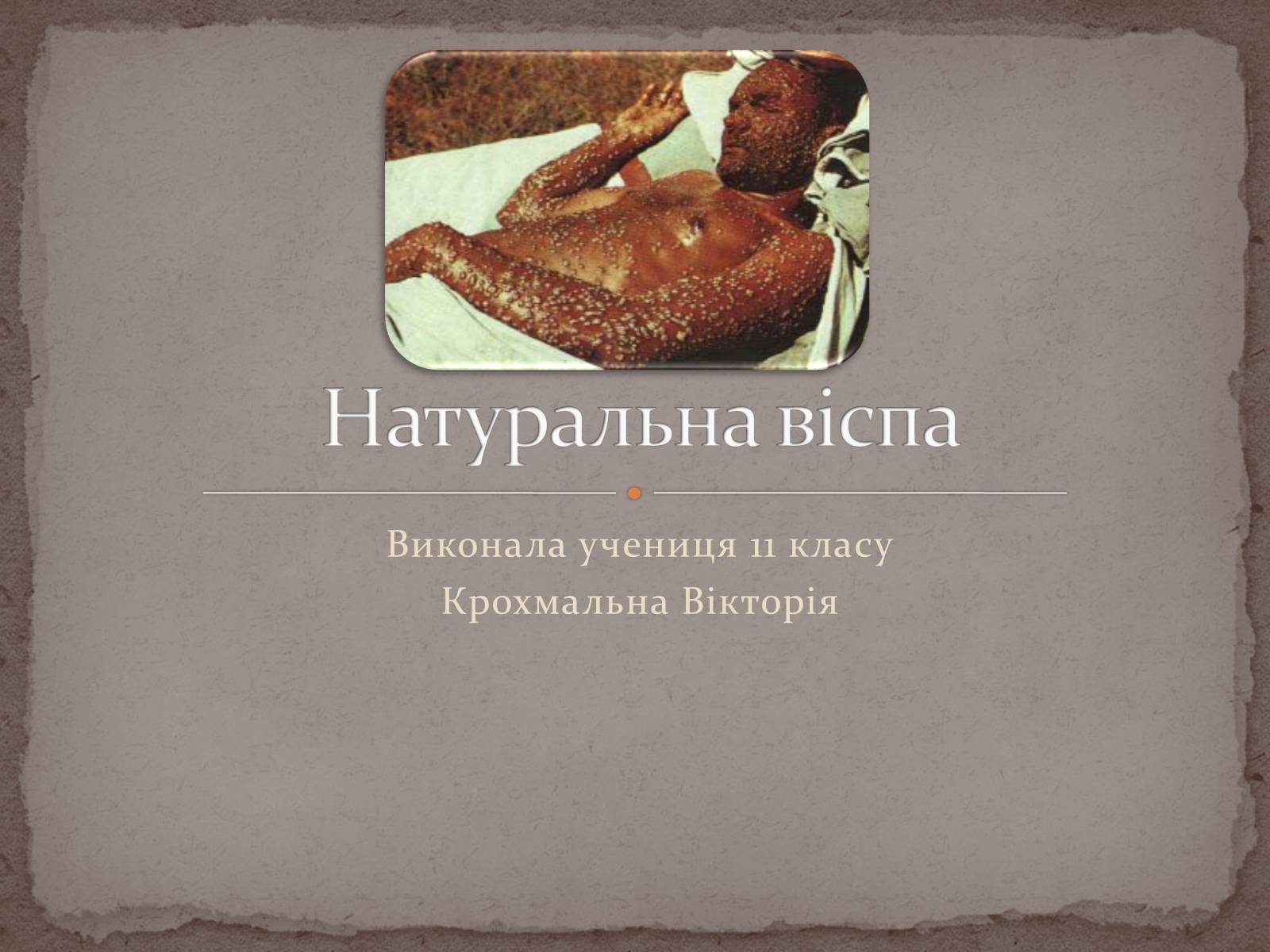 Презентація на тему «Натуральна віспа» - Слайд #1 Презентація на тему «Натуральна віспа» - Слайд #1