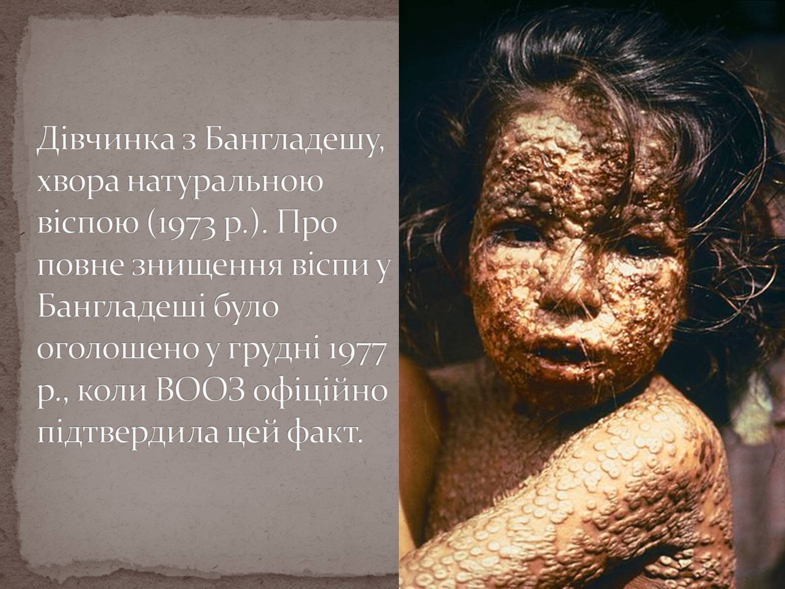 Презентація на тему «Натуральна віспа» - Слайд #3 Презентація на тему «Натуральна віспа» - Слайд #3