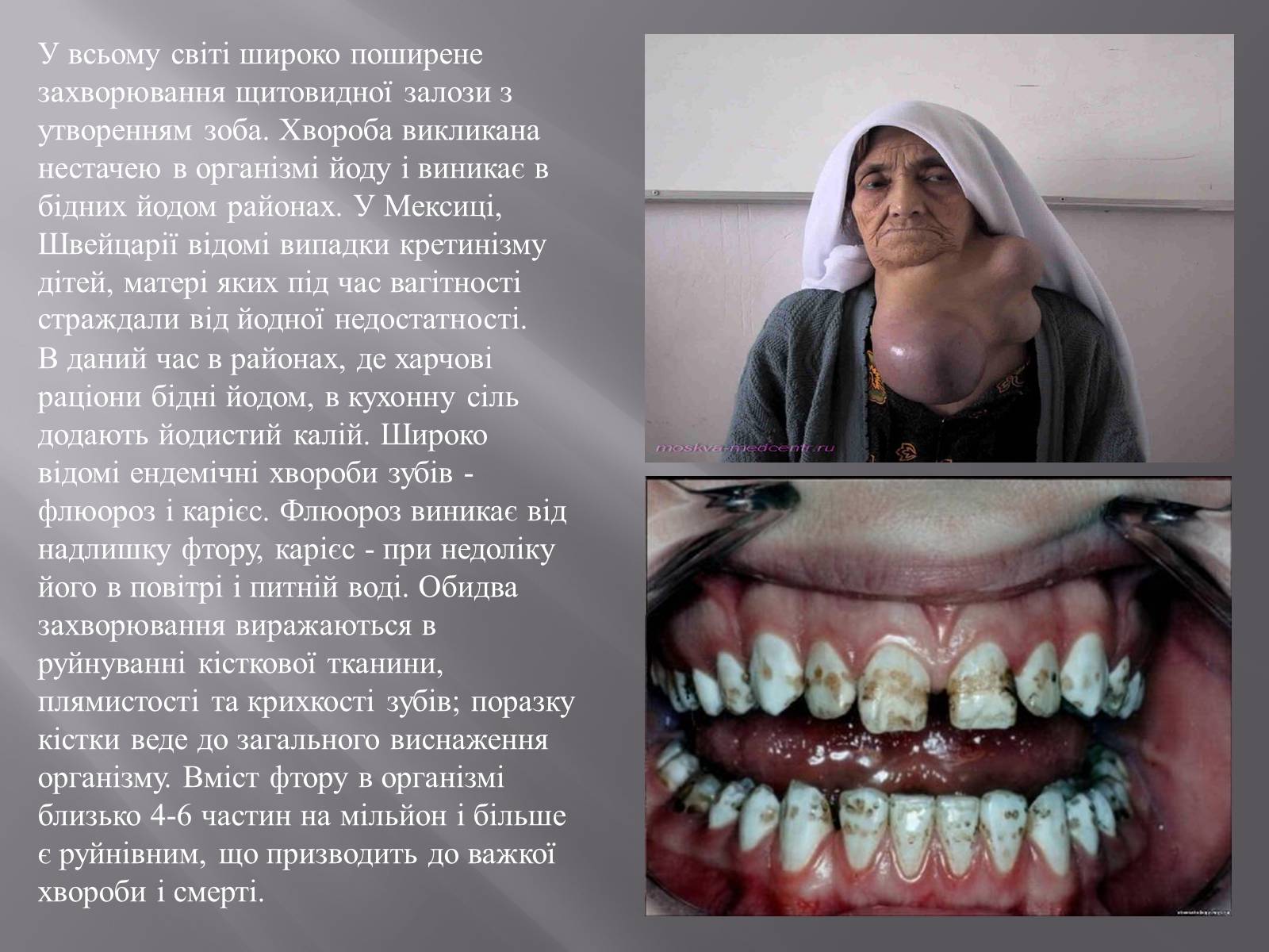 Презентація на тему «Ендемічні захворювання» (варіант 2) - Слайд #6 Презентація на тему «Ендемічні захворювання» (варіант 2) - Слайд #6