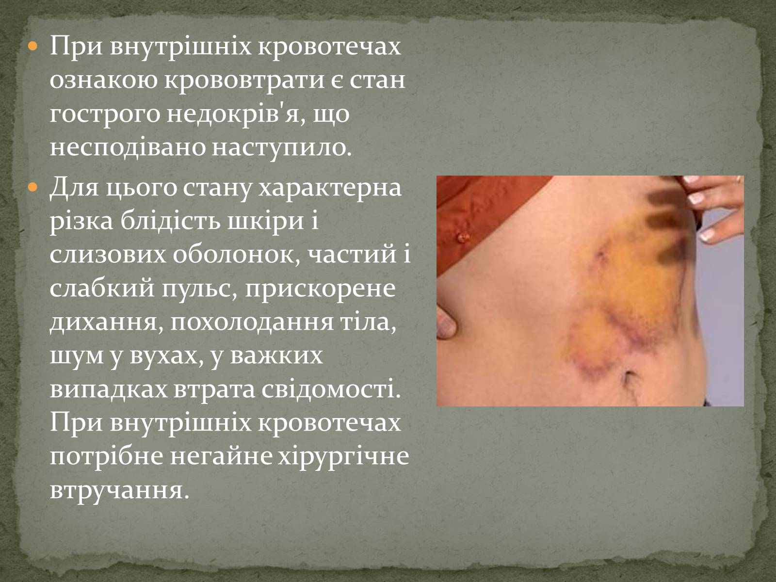 Презентація на тему «Види кровотеч» (варіант 1) - Слайд #12 Презентація на тему «Види кровотеч» (варіант 1) - Слайд #12