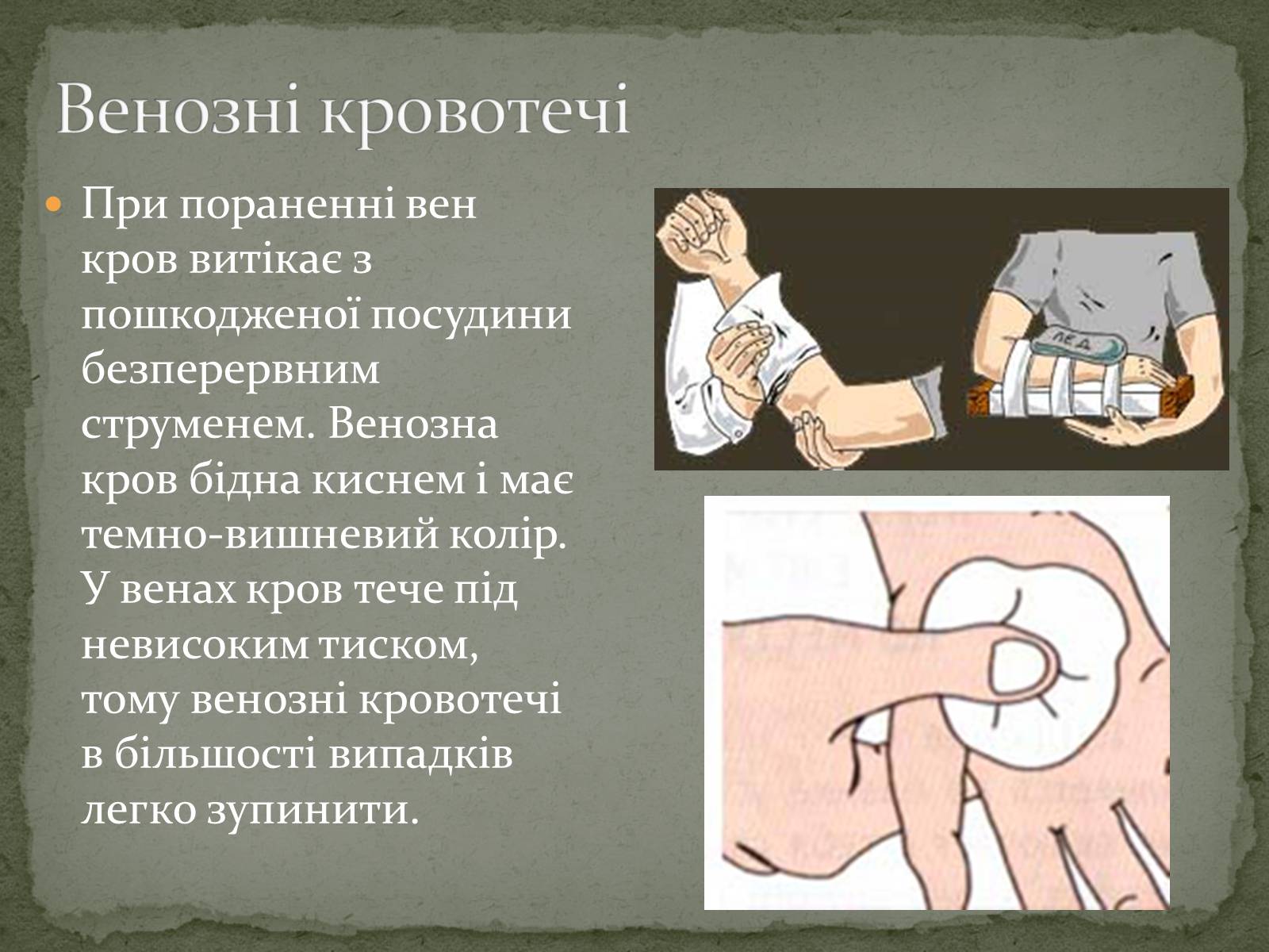 Презентація на тему «Види кровотеч» (варіант 1) - Слайд #6 Презентація на тему «Види кровотеч» (варіант 1) - Слайд #6