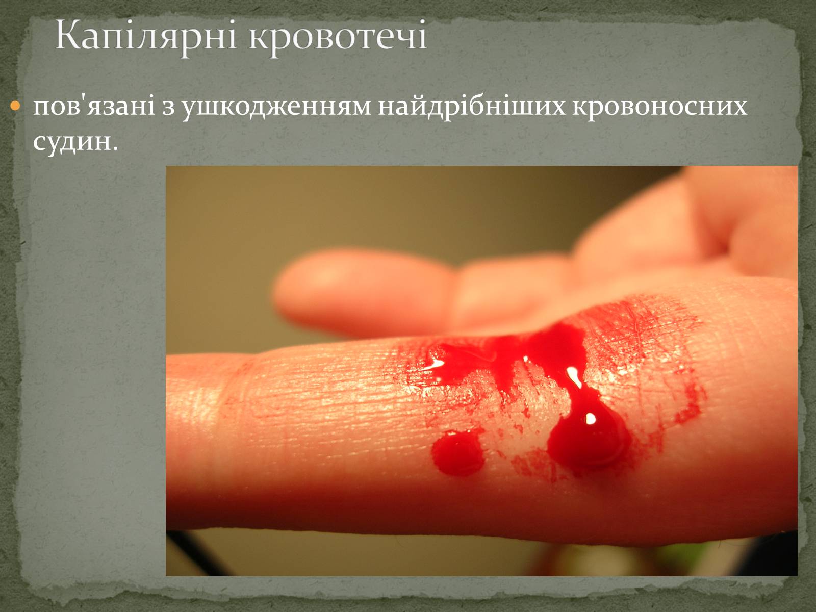 Презентація на тему «Види кровотеч» (варіант 1) - Слайд #9 Презентація на тему «Види кровотеч» (варіант 1) - Слайд #9