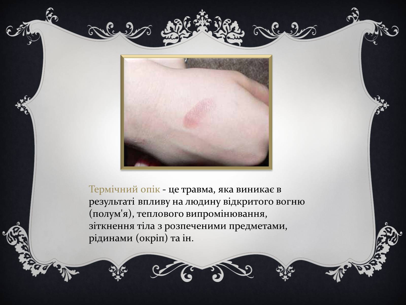 Презентація на тему «Надання першої медичної допомоги притепловомута сонячному ударах, обмороженні та опіках» - Слайд #19 Презентація на тему «Надання першої медичної допомоги притепловомута сонячному ударах, обмороженні та опіках» - Слайд #19