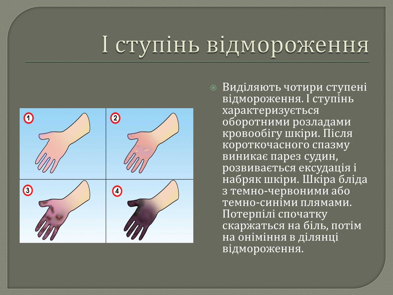 Презентація на тему «Відмороження» - Слайд #3 Презентація на тему «Відмороження» - Слайд #3