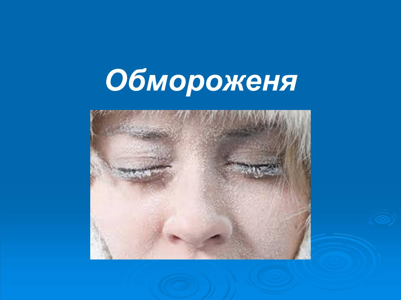 Презентація на тему «Обмороженя» - Слайд #1 Презентація на тему «Обмороженя» - Слайд #1