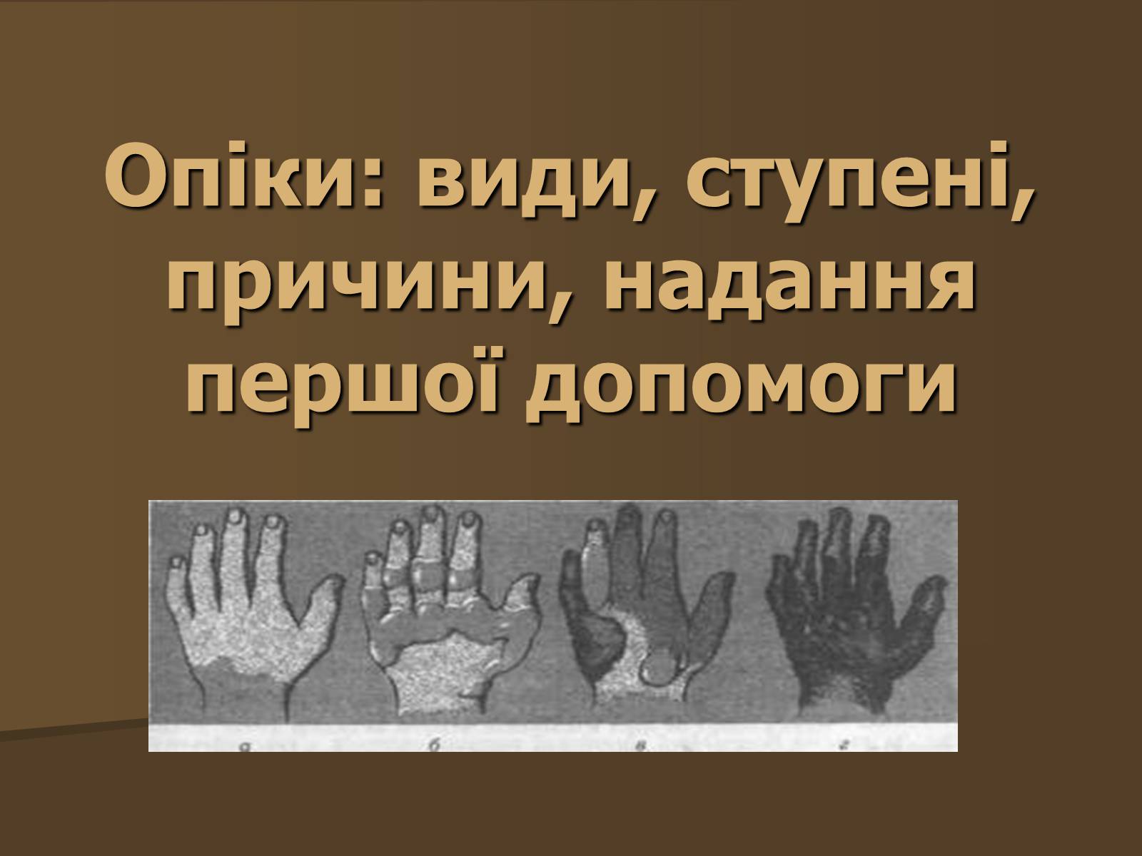 Презентація на тему «Опіки» (варіант 3) - Слайд #1 Презентація на тему «Опіки» (варіант 3) - Слайд #1