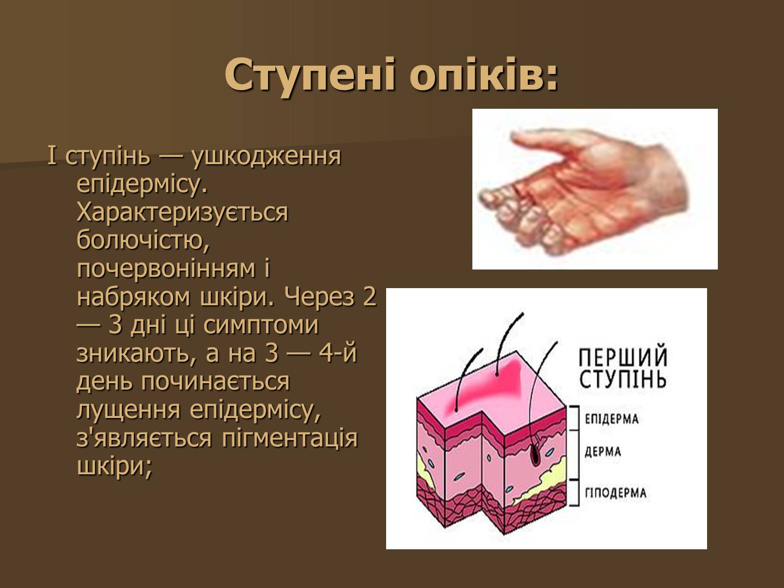 Презентація на тему «Опіки» (варіант 3) - Слайд #8 Презентація на тему «Опіки» (варіант 3) - Слайд #8