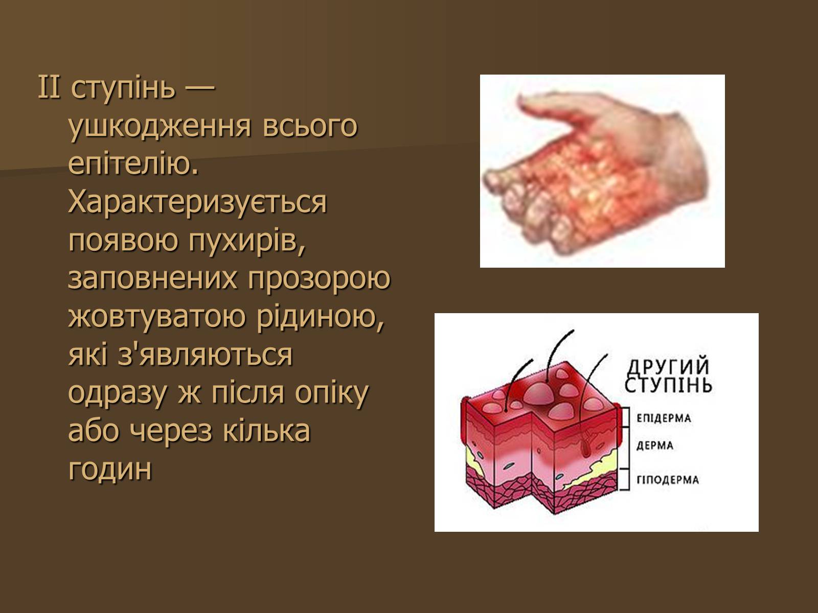 Презентація на тему «Опіки» (варіант 3) - Слайд #9 Презентація на тему «Опіки» (варіант 3) - Слайд #9