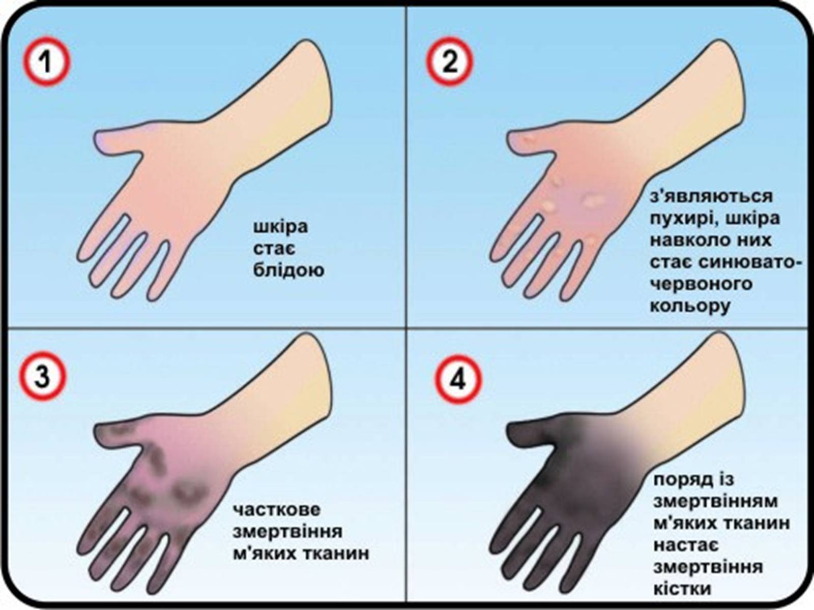 Презентація на тему «Обмороження» (варіант 3) - Слайд #10 Презентація на тему «Обмороження» (варіант 3) - Слайд #10