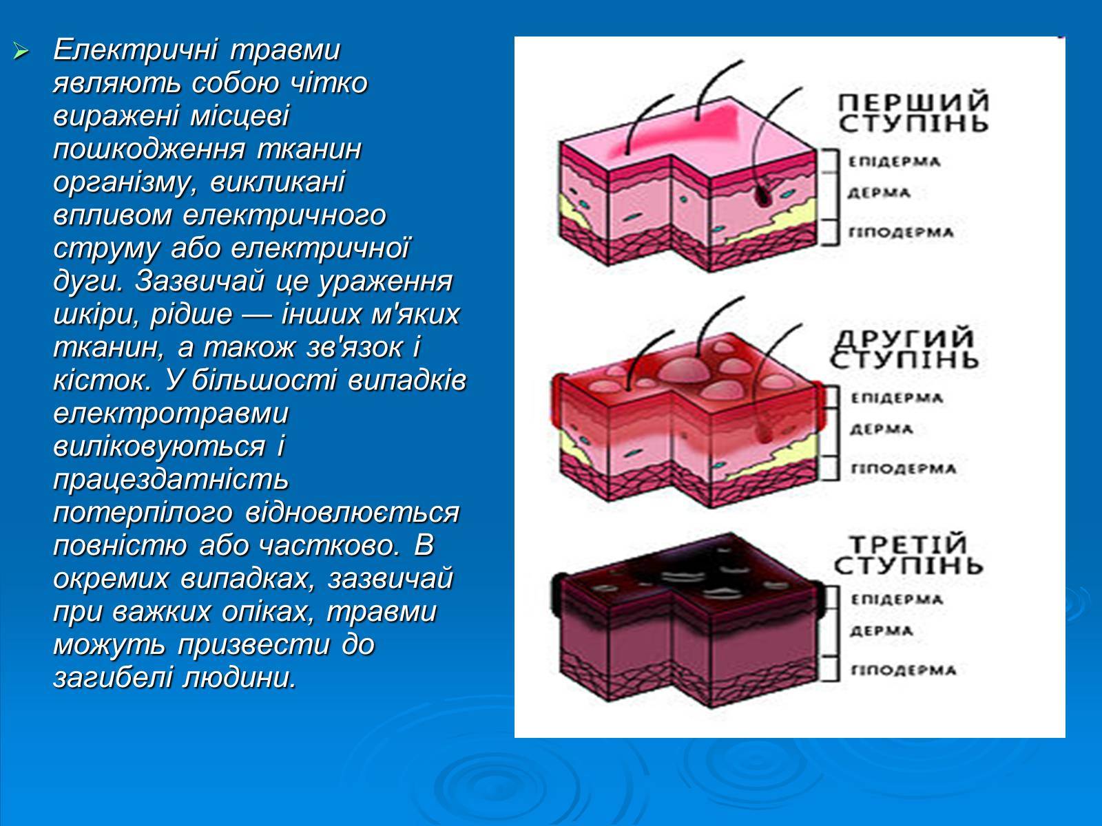 Презентація на тему «Електротравми» (варіант 1) - Слайд #11 Презентація на тему «Електротравми» (варіант 1) - Слайд #11