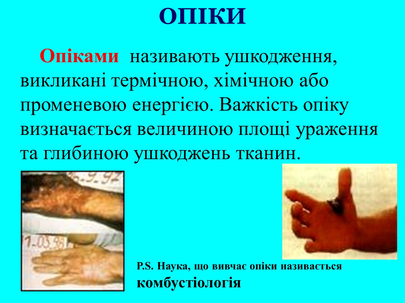 Презентація на тему «Опіки» (варіант 5) - Слайд #2 Презентація на тему «Опіки» (варіант 5) - Слайд #2