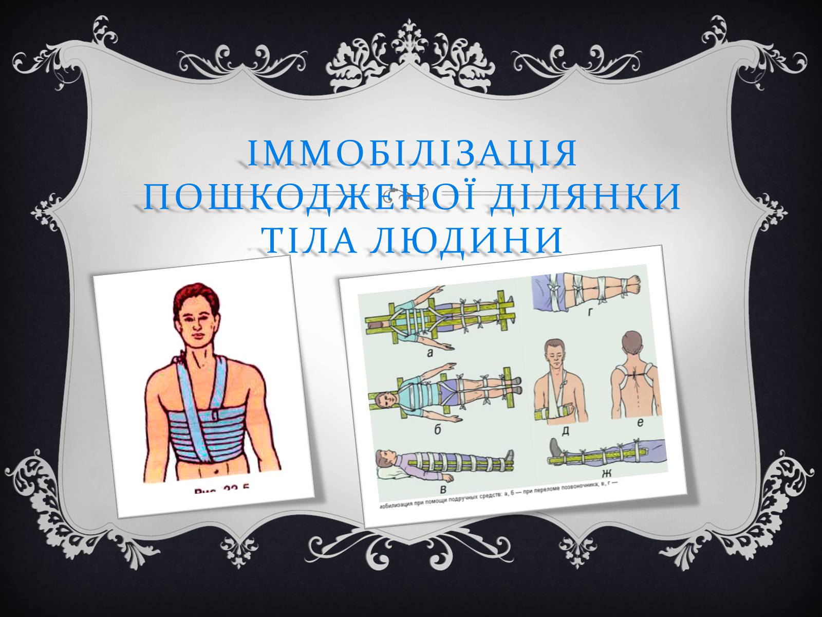 Презентація на тему «Іммобілізація пошкодженої ділянки тіла людини» - Слайд #1 Презентація на тему «Іммобілізація пошкодженої ділянки тіла людини» - Слайд #1