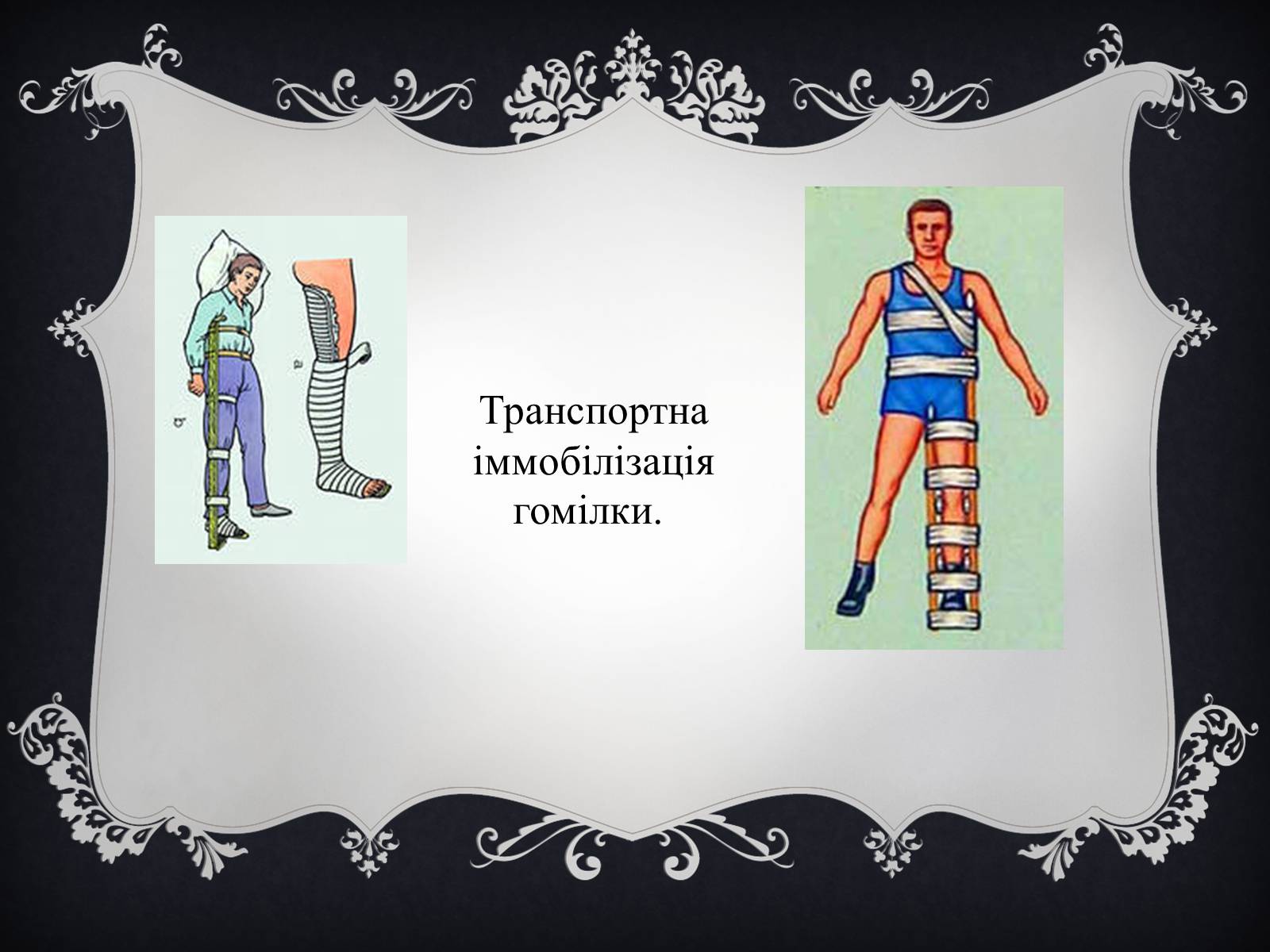 Презентація на тему «Іммобілізація пошкодженої ділянки тіла людини» - Слайд #10 Презентація на тему «Іммобілізація пошкодженої ділянки тіла людини» - Слайд #10