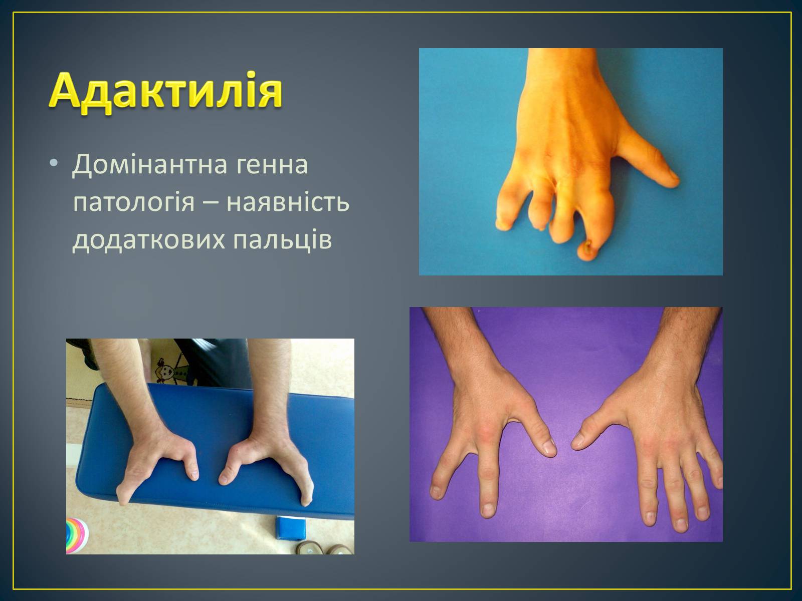 Презентація на тему «Типи генетичних хвороб людини» (варіант 2) - Слайд #7 Презентація на тему «Типи генетичних хвороб людини» (варіант 2) - Слайд #7