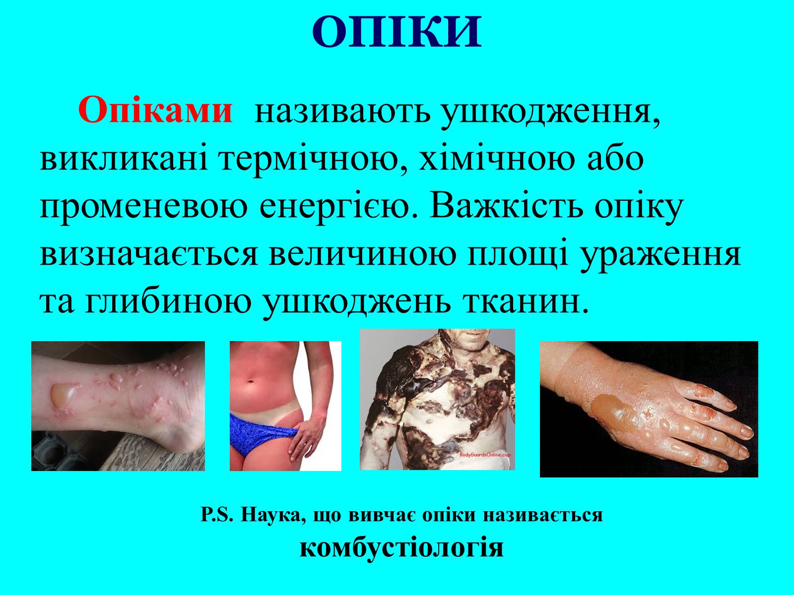Презентація на тему «Опіки» (варіант 7) - Слайд #4 Презентація на тему «Опіки» (варіант 7) - Слайд #4