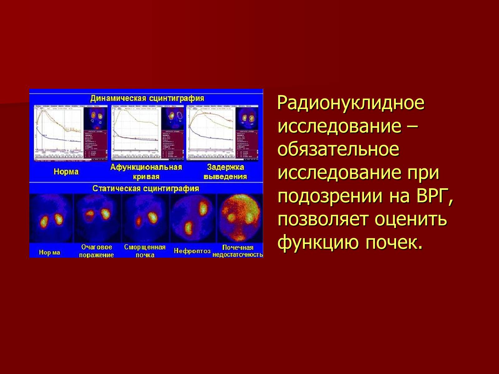 Презентація на тему «Вазоренальная гипертензия» - Слайд #11 Презентація на тему «Вазоренальная гипертензия» - Слайд #11
