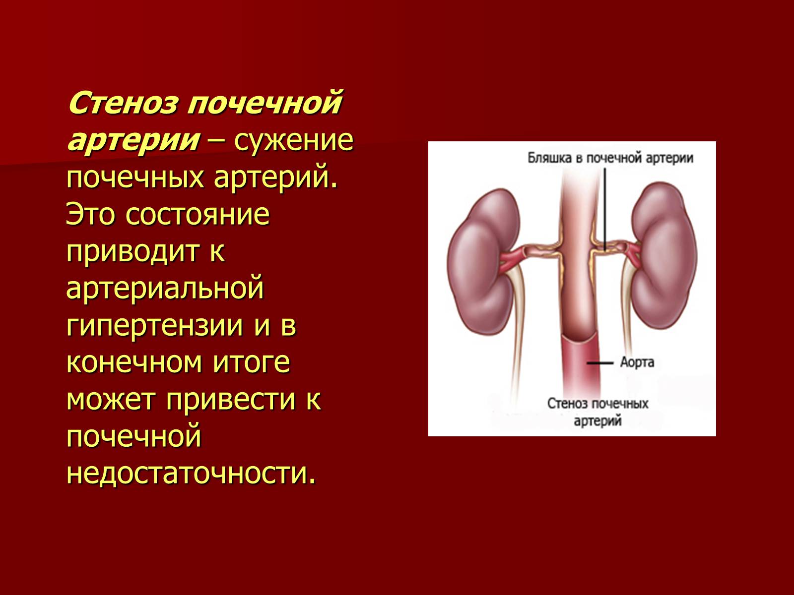 Презентація на тему «Вазоренальная гипертензия» - Слайд #3 Презентація на тему «Вазоренальная гипертензия» - Слайд #3