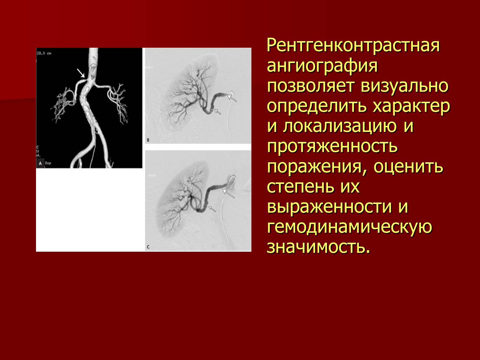 Презентація на тему «Вазоренальная гипертензия» - Слайд #9 Презентація на тему «Вазоренальная гипертензия» - Слайд #9