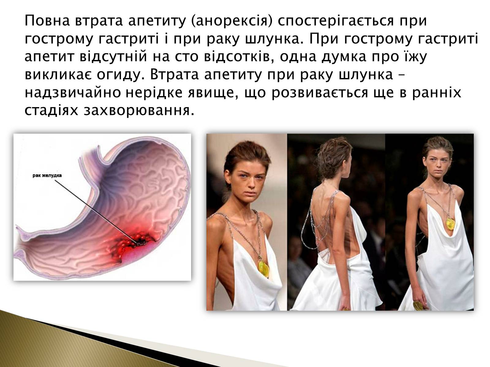 Презентація на тему «Ознаки захворювань шлунка» - Слайд #6 Презентація на тему «Ознаки захворювань шлунка» - Слайд #6