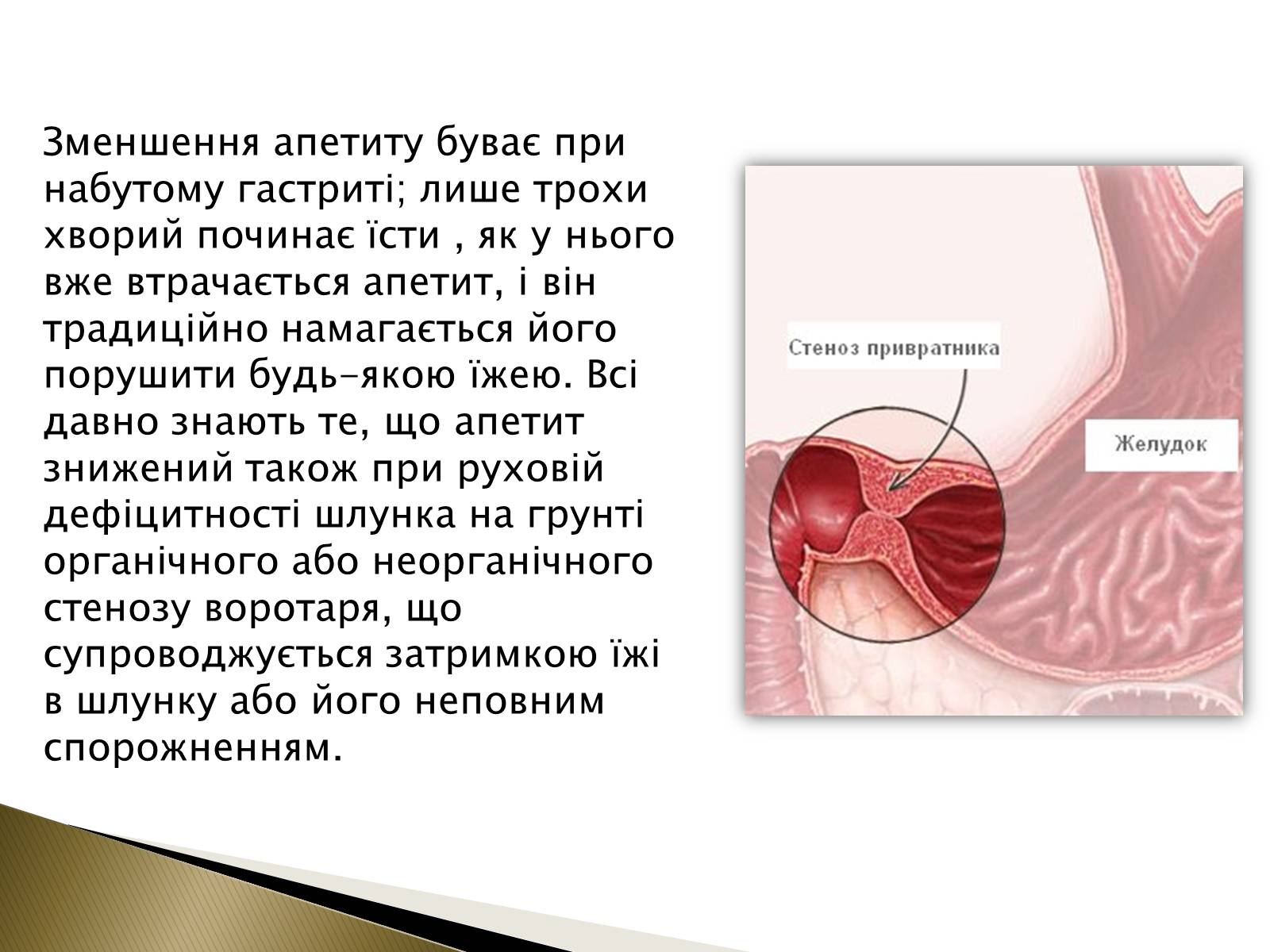 Презентація на тему «Ознаки захворювань шлунка» - Слайд #7 Презентація на тему «Ознаки захворювань шлунка» - Слайд #7