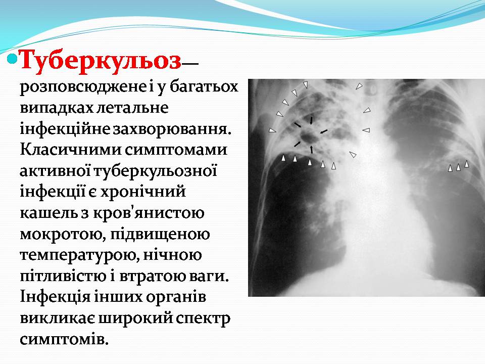 Презентація на тему «Найчастіші захвонювання людей» - Слайд #22 Презентація на тему «Найчастіші захвонювання людей» - Слайд #22