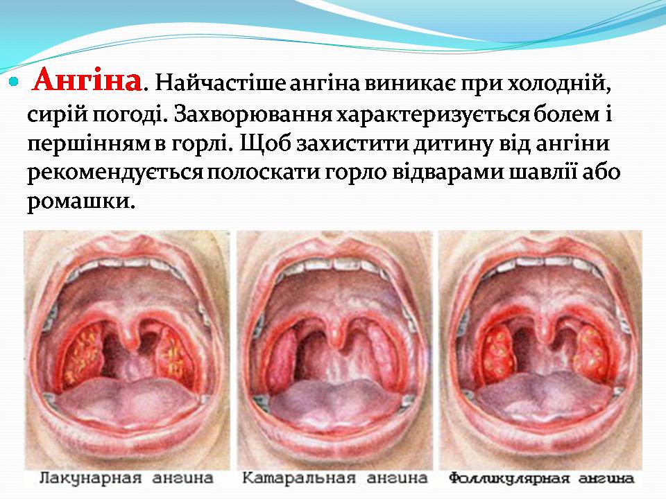 Презентація на тему «Найчастіші захвонювання людей» - Слайд #9 Презентація на тему «Найчастіші захвонювання людей» - Слайд #9