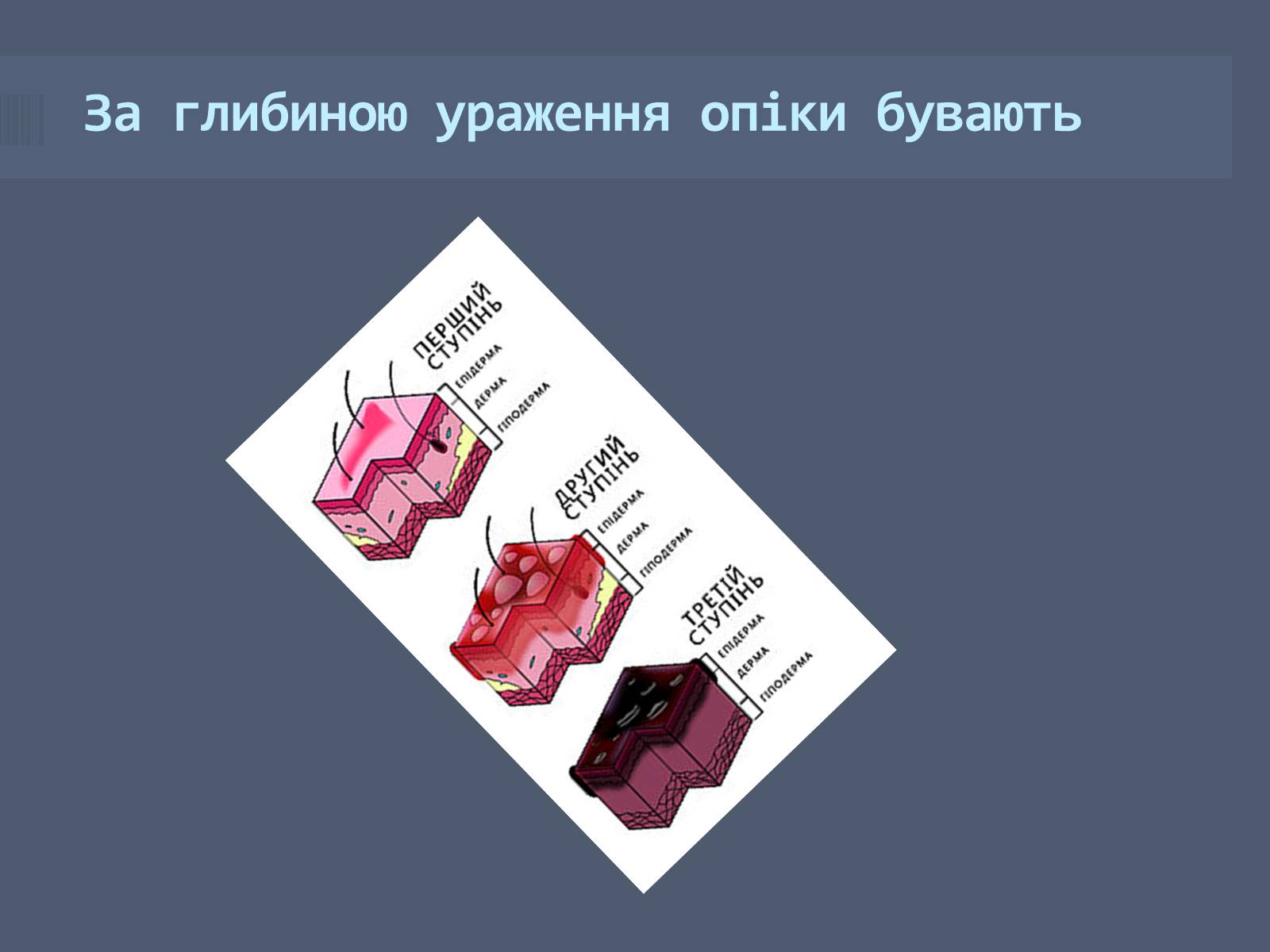 Презентація на тему «Класифікація опіків» - Слайд #11 Презентація на тему «Класифікація опіків» - Слайд #11