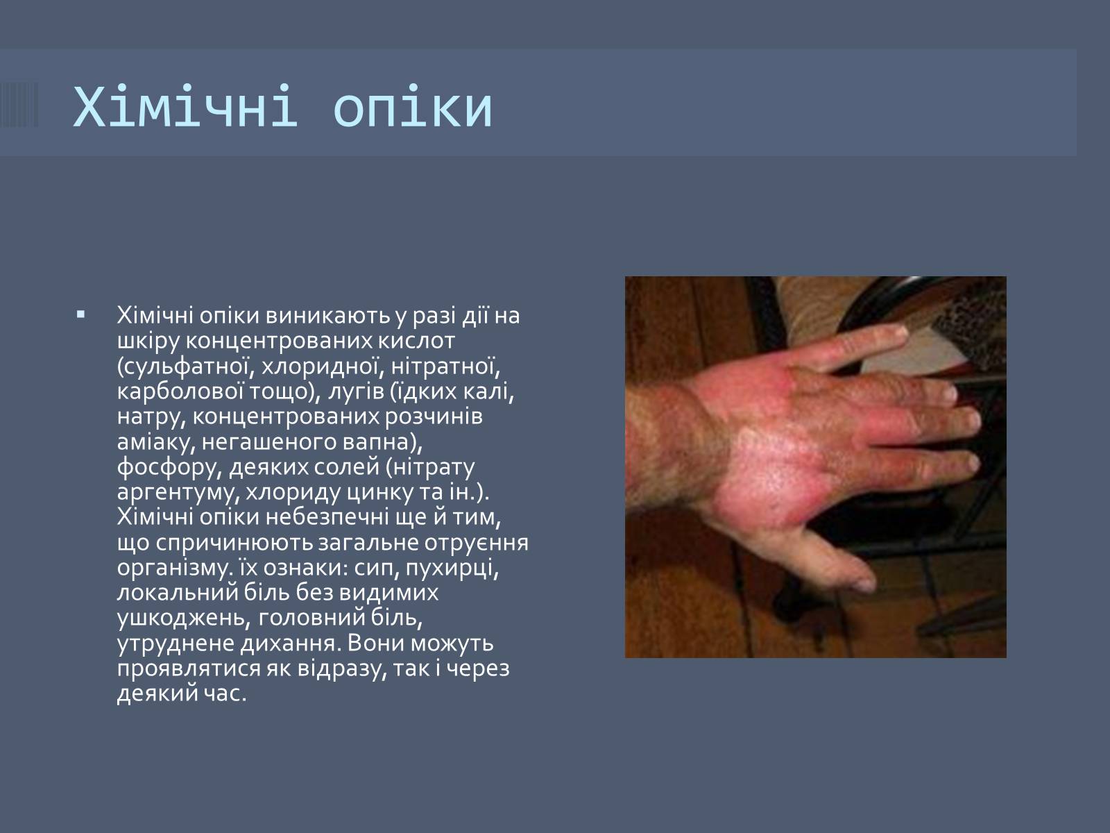 Презентація на тему «Класифікація опіків» - Слайд #9 Презентація на тему «Класифікація опіків» - Слайд #9