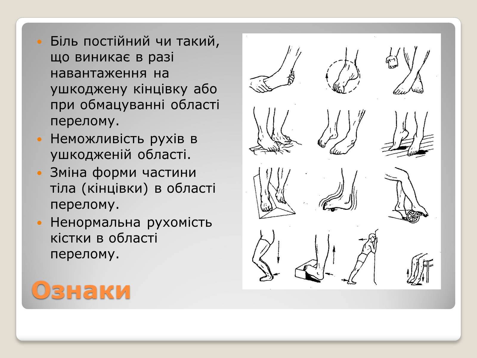 Презентація на тему «Переломи і вивихи» (варіант 3) - Слайд #6 Презентація на тему «Переломи і вивихи» (варіант 3) - Слайд #6
